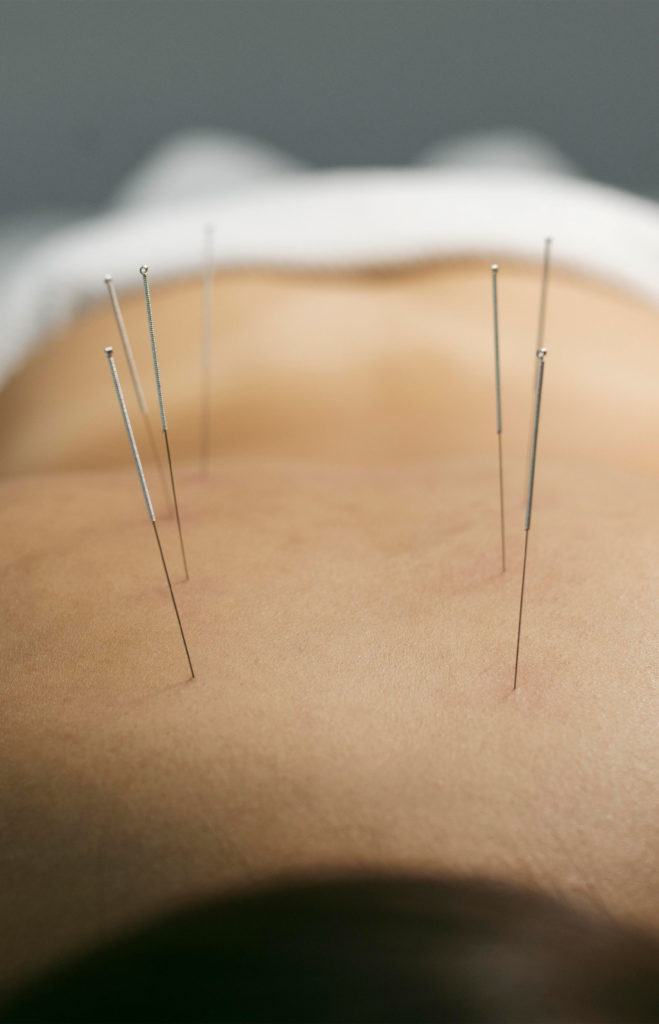 ¿Qué es la acupuntura? | Acupuntura Shin: Bienestar y Salud