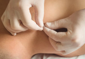 ¿Qué es la acupuntura? | Acupuntura Shin: Bienestar y Salud